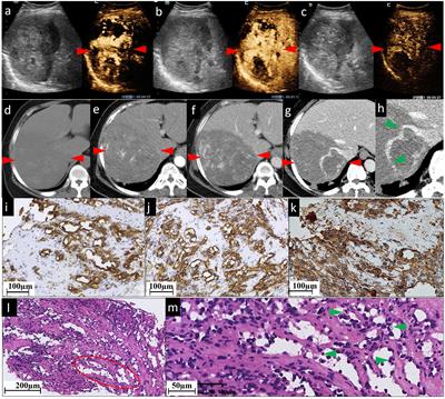 Case Report: The value of contrast-enhanced ultrasound and contrast-enhanced computed tomography in the diagnosis of hepatic angiosarcoma